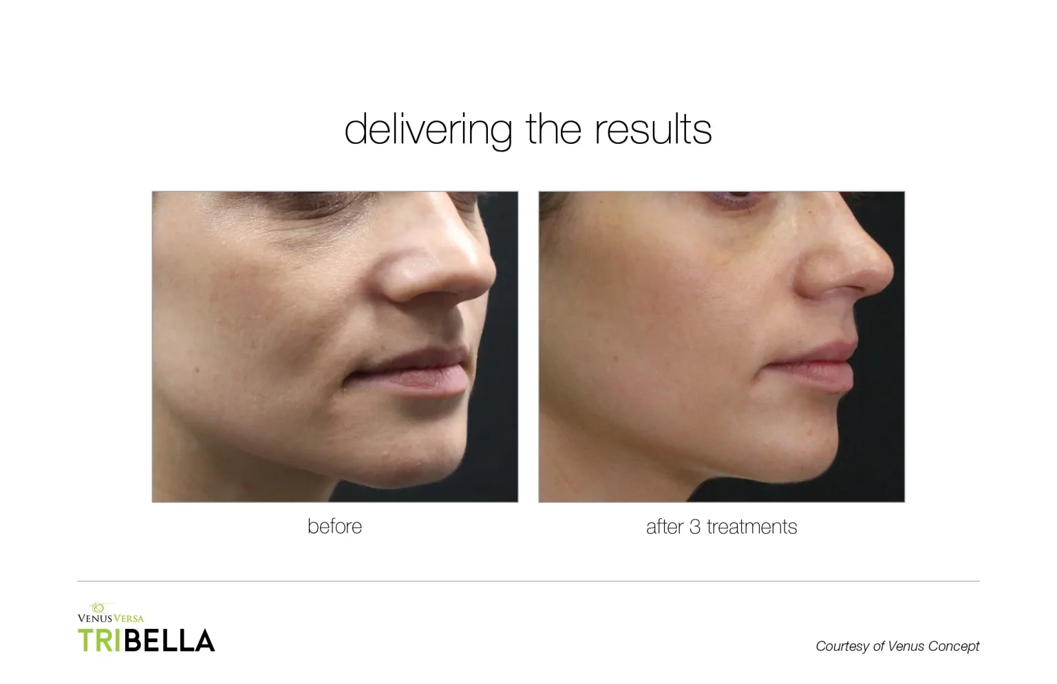 Before and after images of a woman who had the Tribella treatment